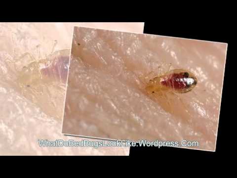 how to treat bed bug rash
