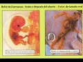 el abortoes un asesinato dentro del vientre