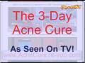 videos de Acne Cure - Incredible!