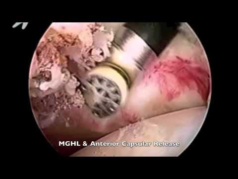 Arthroscopic Capsular Release for Frozen Shoulder