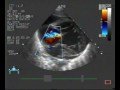 echocardiogram:RV noncompaction3/3 pulmonary hypertension asd tricuspid regurgitation