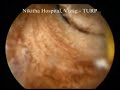 TURP Trans Urethral Resection Prostrate - Urology Video