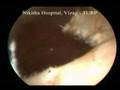 TURP Trans Urethral Resection Prostrate - Urology Video