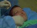 Blepharoplasty