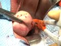 Vaginal Hysterectomy