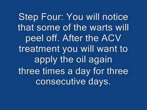 how to treat gw with acv