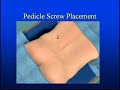 Back [Lumbar] Fusion Surgery for Pain, Sciatica & Stenosis