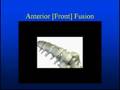Back [Lumbar] Fusion Surgery for Pain, Sciatica & Stenosis