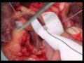 Intervention de Yacoub CTCV Besançon