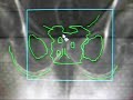 IGRT in cancer prostate with marker tracking daily IGRT in cancer prostate with marker tracking daily