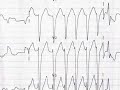 Mistaken  Wide QRS  tachycardia in a elderly person