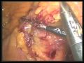 8372GS Laparoscopic Total Proctocolectomy with Vertical, Double-Stapled Ileal-Pouch Anal Anastomosis