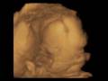 videos de 3D Ultrasound