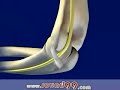 ulnar nerve injury