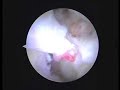 PASTA repair joint side rotator cuff tear ??????????????