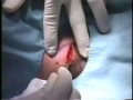 Lipome de la nuque