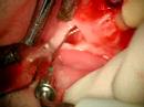 ROOS THIERRY CHIRURGIE ENDODONTIQUE