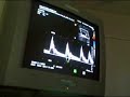 CAROTID ARTERIES ULTRA SOUND #2