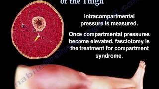 Thigh Compartment Syndrome - Everything You Need To Know - Dr. Nabil Ebraheim