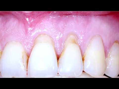 Практикум по пластике мягких тканей десны в области зубов и имплантатов. Часть 9