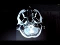Cerveau IRM Imagerie Médicale Système Nerveux Projestes