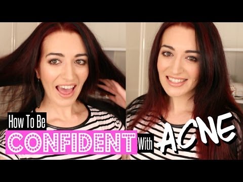how to be confident with acne