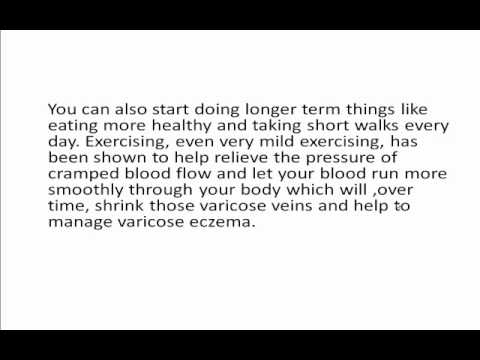 how to treat varicose eczema