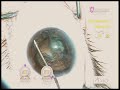 posterior polar cataract surgery by Uday Devgan MD posterior polar cataract surgery by Uday Devgan MD