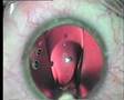 Implantation of Visian ICL - intraocular phakic lens II