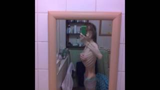 โรคผอม Anorexia