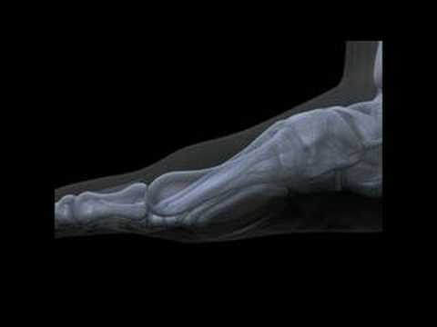 An Animated Explanation of Hallux Limitus and Hallux Rigidus