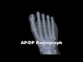Hallux Limitus / Rigidus Surgery Functional Hallux Limitus Arthritis
