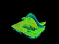 Topcon 3D OCT - PED peeling Topcon 3D OCT - PED peeling