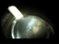 Laser Peripheral Iriditotomy to Prevent Glaucoma Part 2 Laser Peripheral Iriditotomy to Prevent Glaucoma Part 2