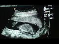 Baby Ultrasound 16 weeks-1