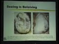 Lecture - HTO in Knee Osteoarthritis - Part 2