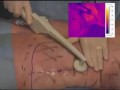 BodyTite Liposuction Skin Tightening Demonstration on Female Patient.flv