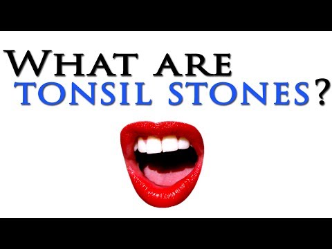 how to cure tonsil stones