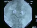 Lee Kirksey MD Vascular Surgeon Angioplasty Penn Presbyteria