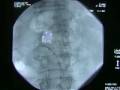 Lee Kirksey MD Vascular Surgeon Angioplasty Penn Presbyteria