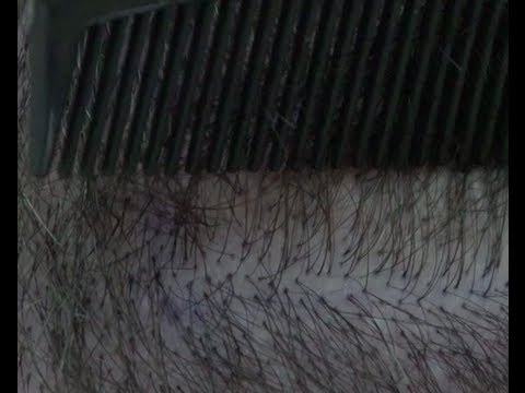 how to remove hair transplant scar