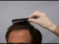 CIT/Hair Transplant Results/5000 Grafts/Dr. Cole