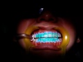 Blanqueamiento Dental Profesional