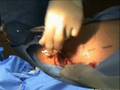 LASE Varicose Vein Treatment