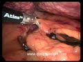 Gastric banding in a patient with advanced liver cirrhosis