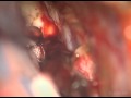 Cavernous Malformations of the Brainstem: A Supracerebellar Infratentorial Approach