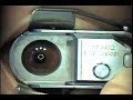 Epi-Lasek Surgery by Dr Chynn Epi-Lasek Surgery by Dr Chynn