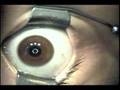 Epi-Lasek Surgery by Dr Chynn