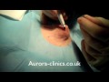 www.aurora-clinics.co.uk Inverted nipples affect 10% of women. Nipple inversion causes significant embarrassment and can be corrected simply under Local Anaesthetic. In this video Mr Richards shows you how surgery is done. A FREE informational Audio CD containing all the facts you need to know about this procedure is available from Aurora Clinics. Please complete the form on the attached link www.aurora-clinics.co.uk