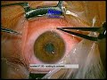 corneal injury repair by docdepe Easter holiday